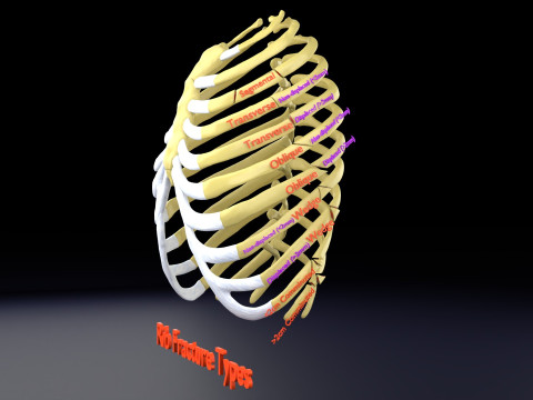 Rib fracture and its types Model 3D