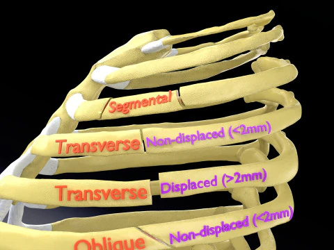 Rib fracture and its types 3D Model