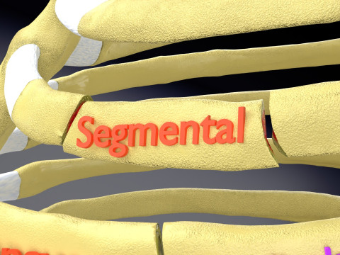 Rib fracture and its types Model 3D