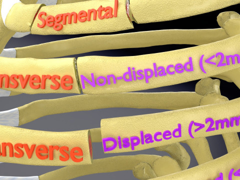 Rib fracture and its types Model 3D