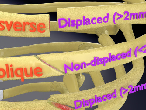 Rib fracture and its types Model 3D