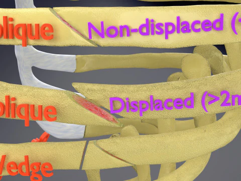 Rib fracture and its types 3D Model