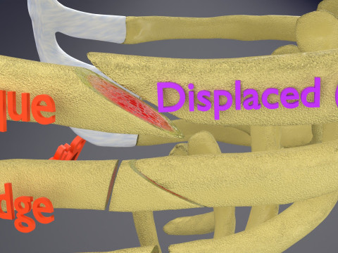 Rib fracture and its types Model 3D