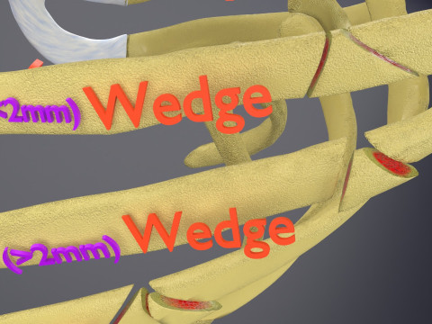 Rib fracture and its types Model 3D
