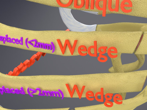 Rib fracture and its types Model 3D