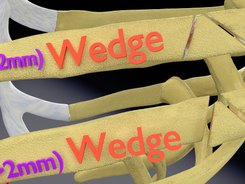 Rib fracture and its types Model 3D