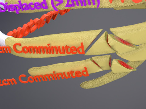 Rib fracture and its types Model 3D