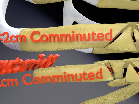 Rib fracture and its types Model 3D