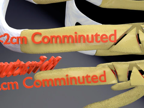Rib fracture and its types 3D Model