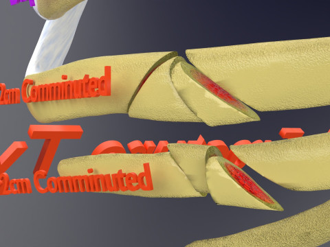 Rib fracture and its types Model 3D