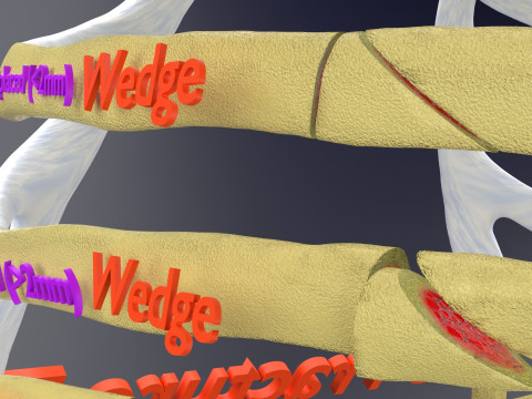 Rib fracture and its types Model 3D