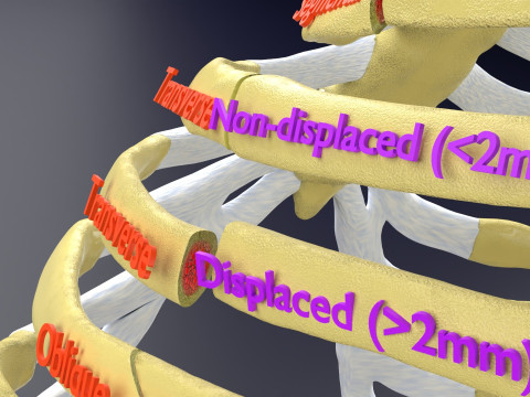 Rib fracture and its types Model 3D