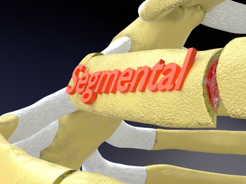 Rib fracture and its types Model 3D