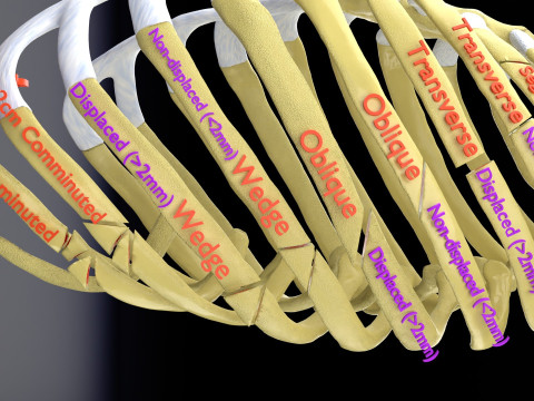 Rib fracture and its types Model 3D