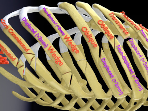 Rib fracture and its types Model 3D
