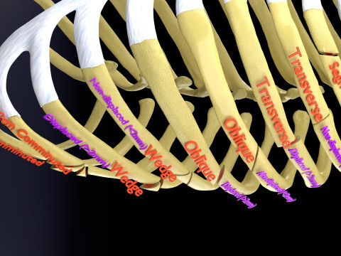 Rib fracture and its types Model 3D