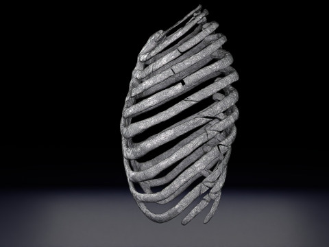Rib fracture and its types Model 3D