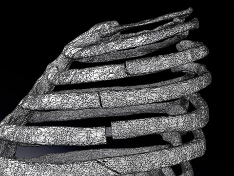 Rib fracture and its types Model 3D