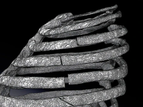 Rib fracture and its types 3D Model