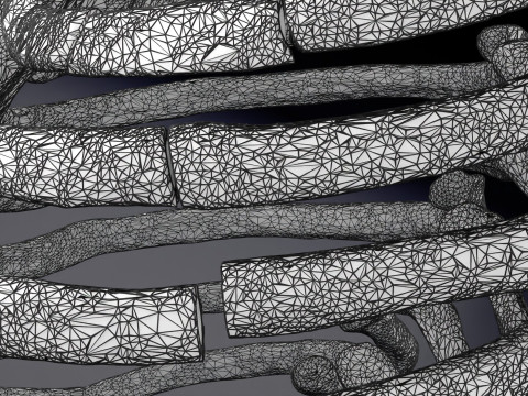Rib fracture and its types Model 3D