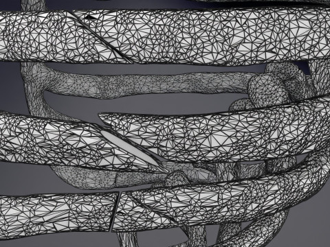 Rib fracture and its types Model 3D