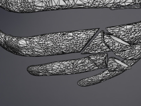 Rib fracture and its types Model 3D