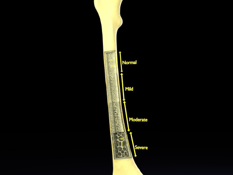 Osteoporosis and its stages 3D Model