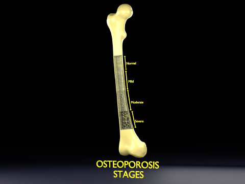 Osteoporosis and its stages Model 3D