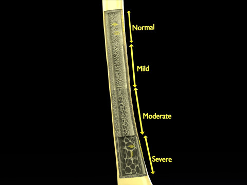 Osteoporosis and its stages Model 3D