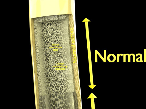 Osteoporosis and its stages Model 3D