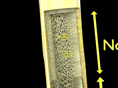 Osteoporosis and its stages Model 3D