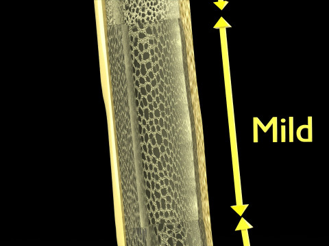 Osteoporosis and its stages Model 3D