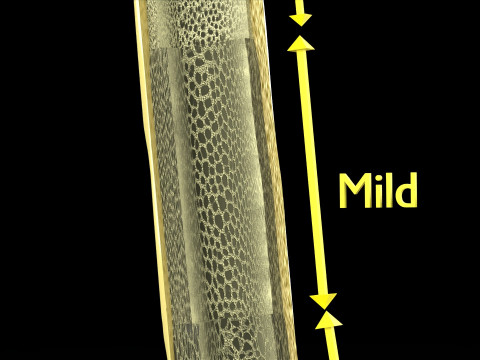 Osteoporosis and its stages Model 3D