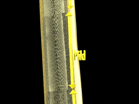 Osteoporosis and its stages Model 3D