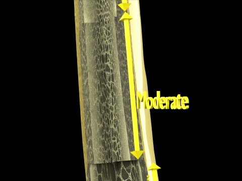 Osteoporosis and its stages Model 3D