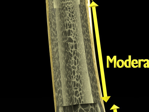 Osteoporosis and its stages Model 3D