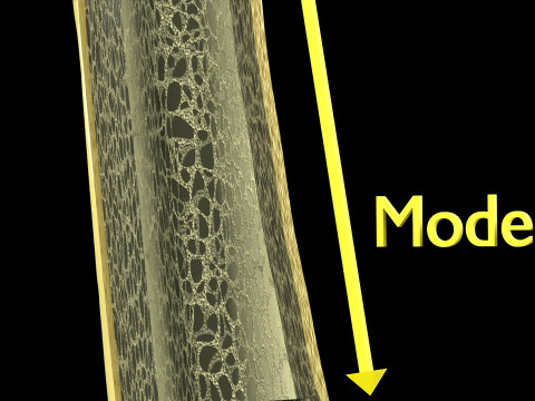 Osteoporosis and its stages Model 3D