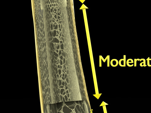 Osteoporosis and its stages Model 3D