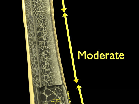 Osteoporosis and its stages Model 3D