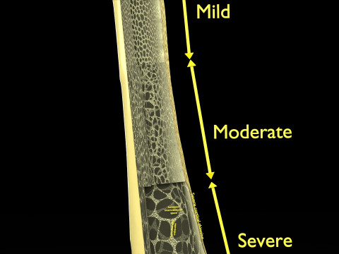 Osteoporosis and its stages Model 3D