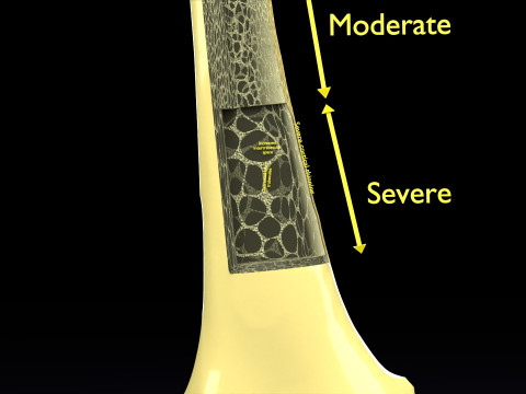 Osteoporosis and its stages Model 3D