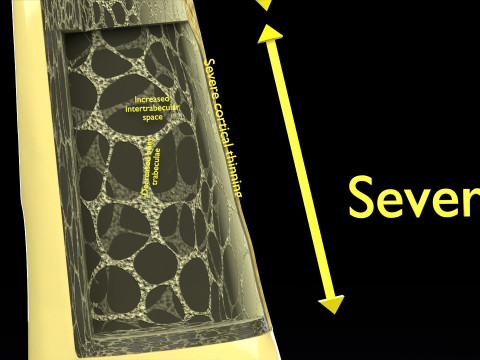 Osteoporosis and its stages Model 3D
