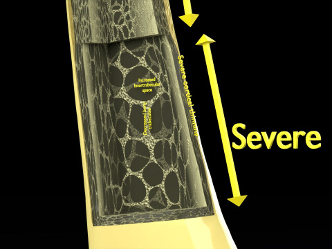 Osteoporosis and its stages Model 3D