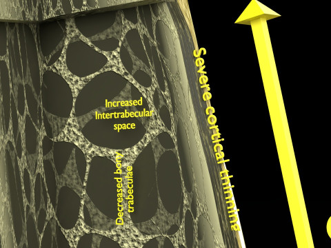 Osteoporosis and its stages Model 3D