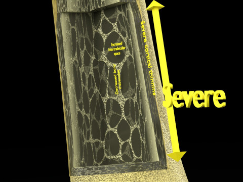 Osteoporosis and its stages Model 3D
