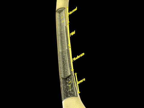 Osteoporosis and its stages Model 3D