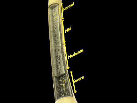 Osteoporosis and its stages Model 3D