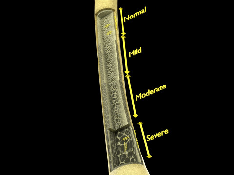 Osteoporosis and its stages Model 3D