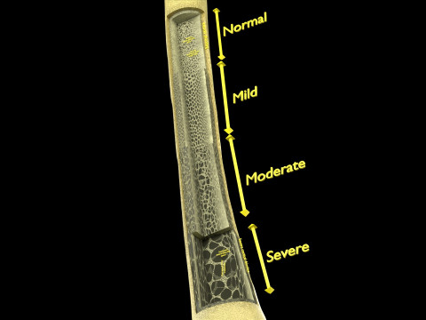 Osteoporosis and its stages Model 3D