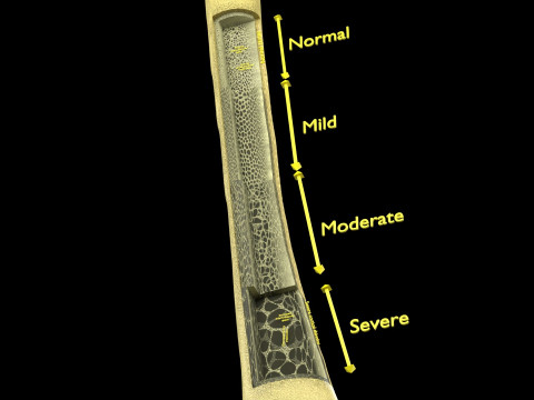 Osteoporosis and its stages Model 3D